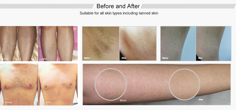 Pulse Mode Permanent Hair Removal Laser Machine , 808nm Painless Hair Removal Machine