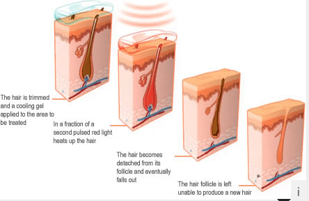 L'épilation de chargement initial d'affichage à cristaux liquides usine la machine de beauté de rajeunissement de peau pour l'usage de salon