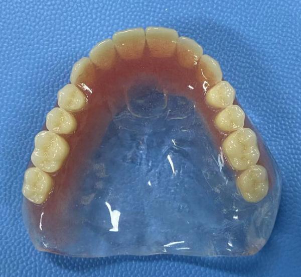 Hypoallergenic Customized Removable Partial Denture With Pink Gum Color