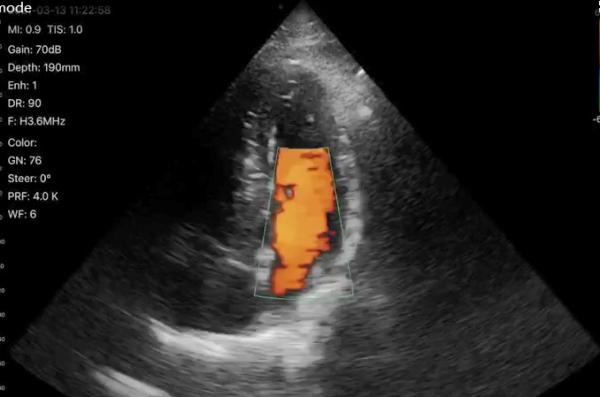 Wireless Phased Array Ultrasound Transducer Handheld Cardiac Echography Wireless Ultrasound Probe Price for Sale