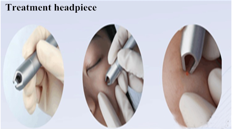 Proliferative Lesion Cherry Angiomas Vein Machine 15W Handheld