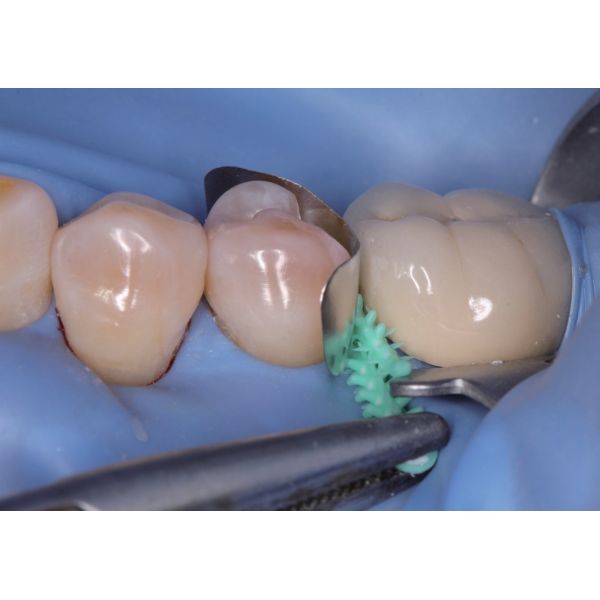 Composite Dental Sectional Matrix System Plastic Adaptive Wedges W3 1.0