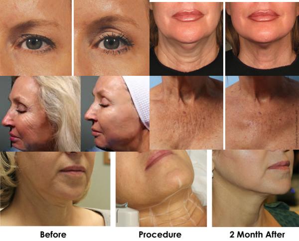 high frequency HIFU face firming HIFU-f face lift machine face smooth wrinkle removal