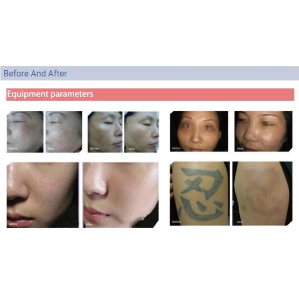 2 - машина удаления татуировки оборудования удаления татуировки лазера размера места 8мм портативная