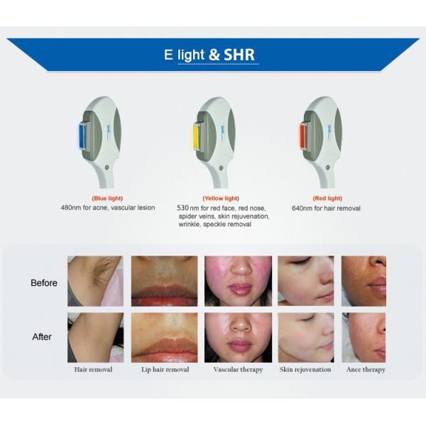 Оборудование красоты удаления волос машины удаления волос лазера OPT SHR IPL постоянное