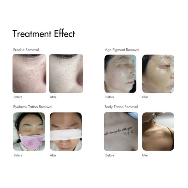 Наивысшая мощность q переключила машину удаления пигмента удаления татуировки лазера Nd Yag с 532Nm 1064Nm