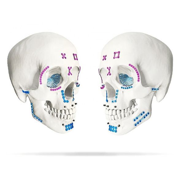 Maxillofacial Mini Locking Straight Plate 1.0mm Thickness Titanium