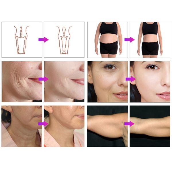 Professional 5 in 1 Skin Facial Lifting Multi-lines 8D Hif Body-slim Lipo Hif Vaginal Tightening Hif Beauty Machine 2025