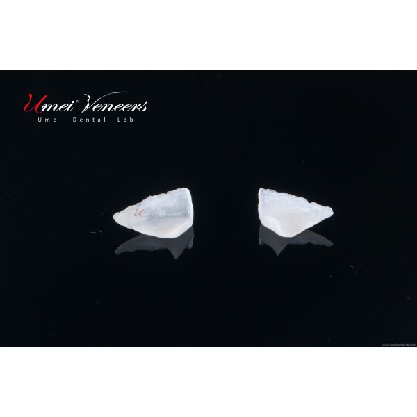 Customized ultra-thin dental veneer