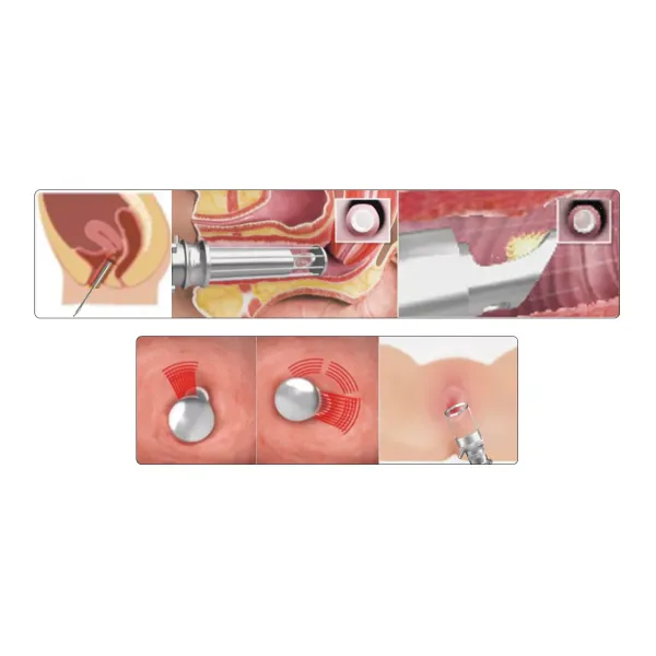 Машина лазера RF СО2 частичная для удаления угорь обработки стороны