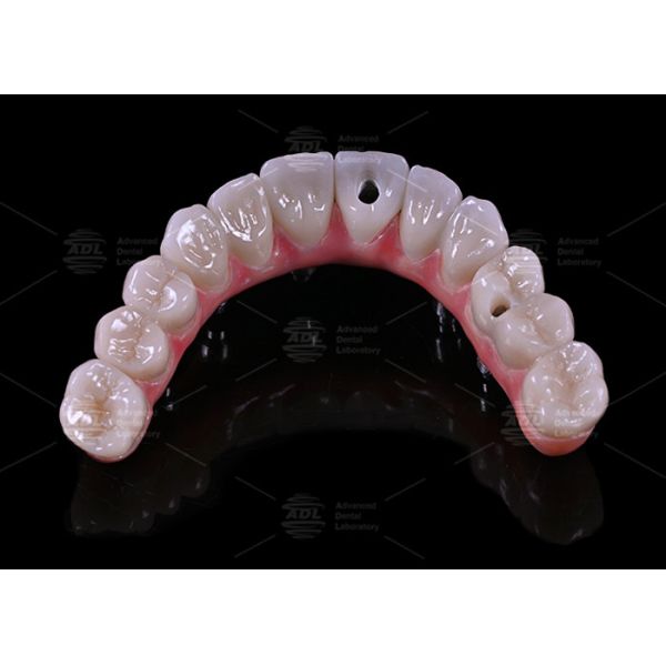 China Dental Lab Titanium Screw Retained Malong Design A1 Shade Full Arch Hybrid Bridge