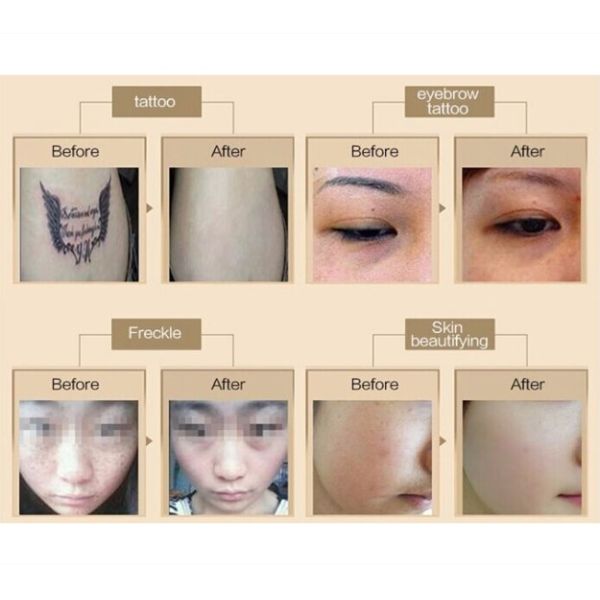 Máquina de eliminación de tatuajes sin dolor Q Switch Máquina de eliminación de tatuajes profesional 532nm