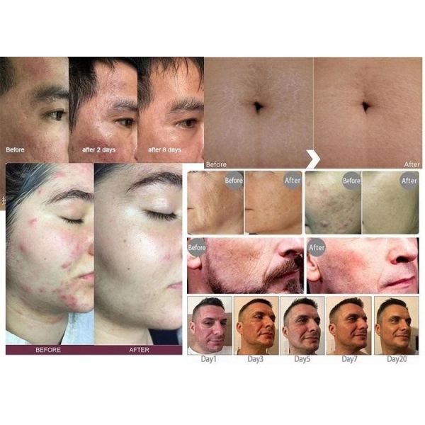 Машина лазера удаления шрама угорь машины RF Microneedling 2 ручек Nano