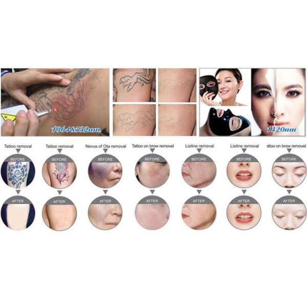 Professional Q-switched Nd yag laser tattoo removal machine with low price