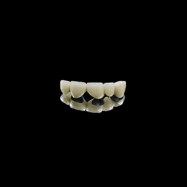 Best Teeth Craftsman Porcelain-Fused-to-Metal (PFM) Crowns