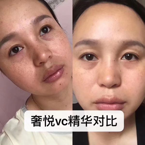 VC for face skin