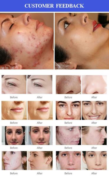 Máquina de Dermoabrasão Hydra 200W Máquina de Microdermoabrasão de Peeling de Diamantes 8 em 1