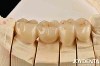 Unleash Aesthetics Of High Aesthetics Full Zirconia With White And Resistance To Thermal Shock High