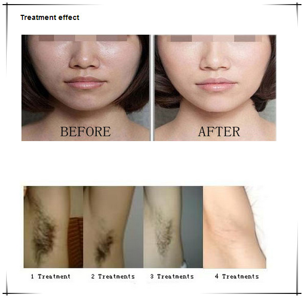 Professional 2 handpiece pain free hair removal / freckle removal SHR ipl machine