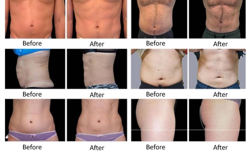 10,4» углов 360 окружая замораживание Cryolipolysis жирное уменьшая машину для жирного удаления