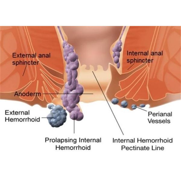 1470nm Proctology Medical Diode Laser Hemorrhoid Treatment
