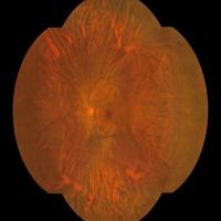 176 Deg Wide Angle Fundus Camera With One Key Operation And Binocular Capture For Ophthalmic Medical Devices