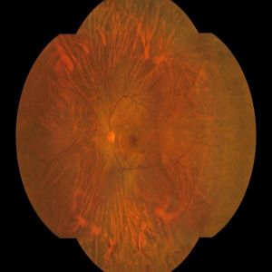 Advanced Automated Perimetry Machine with Wide Field of View 176° and Resolution LED True Color Imaging Technology