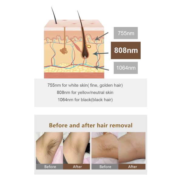 Hair Removal Laser 808 Ice Cooling Technology Laser Hair Removal Machine Microdermabrasion Machine
