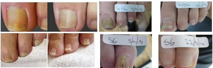 машина удаления вены паука 980nm