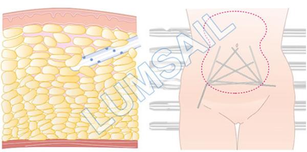 Body Contouring Power Assisted Liposuction Equipment For Body Sculpting Treatments