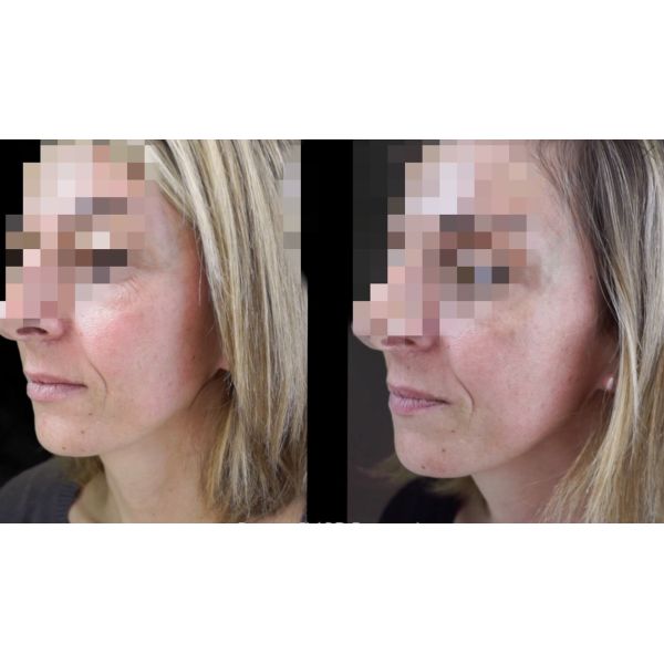 Тип токсина  Botulinum отрава добавляет 2ml - нормальное соляное 2.5ml