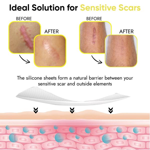 OEM 3.5x15cm Silicone Scar Patch Sheets Tape For Keloid Tummy Tuck Acne Removal