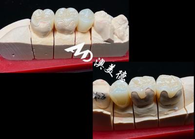 OEM Inlays e Onlays Cerâmicos de Precisão para Restauração Dental Natural Forte