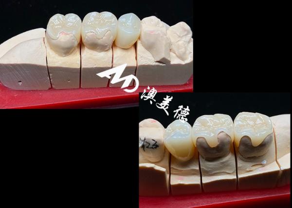OEM Inlays e Onlays Cerâmicos de Precisão para Restauração Dental Natural Forte