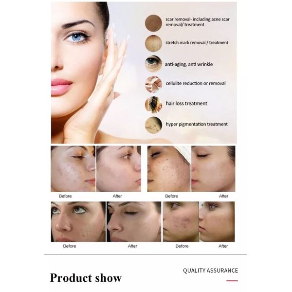 Профессиональная ручка Microneedling - беспроводная ручка Derma автоматическая - самый лучший инструментальный ящик заботы кожи для стороны и тела