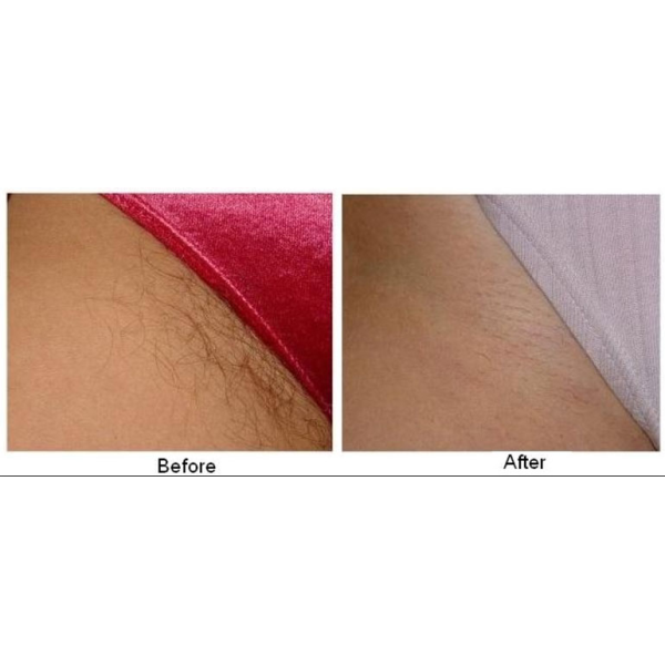 Portable IPL RF Beauty Equipment 808nm Diode Laser Hair Remove For Bikini Line