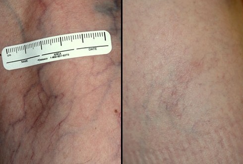 8.4 inch touch screen laser spider vein removal machine for clinic use
