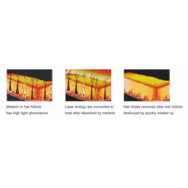 Переносная IPL RF ND YAG лазерная косметическая машина для удаления волос для лечения прыщей