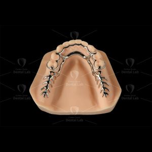 Metal Partial Dentures