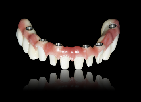 ALL On  X Implant Zirconia Bridge Implant Crown Bridge Natural Appearance