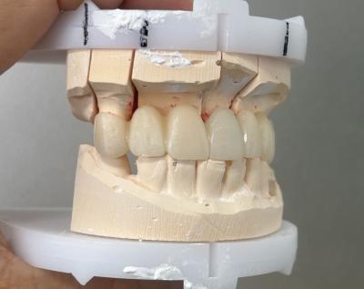 Full Zirconia Bridge with 1200 MPa Strength High Translucency and Metal-Free for Superior Dental Restorations