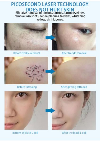 Máquina comutada Q médica do laser do Nd Yag, máquina da remoção da tatuagem do laser da beleza
