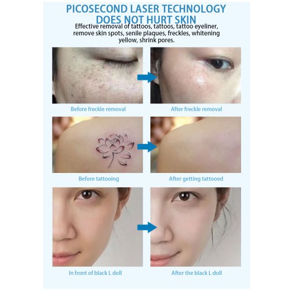 Медицинская переключенная q машина лазера Nd Yag, машина удаления татуировки лазера красоты