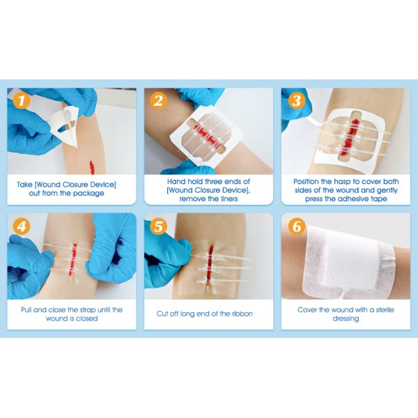 PWT1003 Flexible Fabric Bandages Wound Closure Device 6PCS