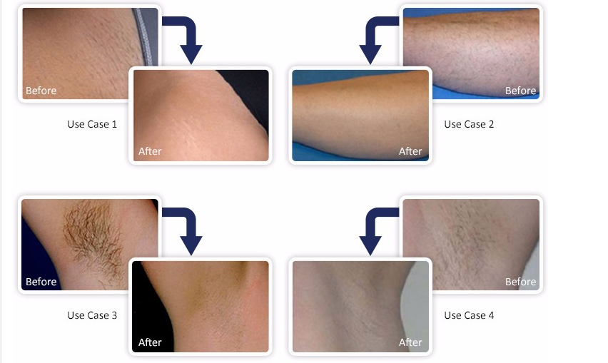 Customized Laser Hair Removal Machine With Cooling Spot Size 12mm*12mm