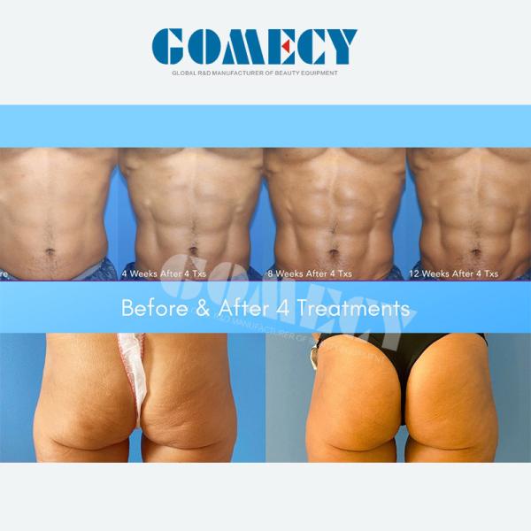 Hot Sale Trusculpt Flex Slim Body Sculpting Slimming Machine Trusculpt Emsmuscle Stimulator Newangi Group Trusculpt Flex