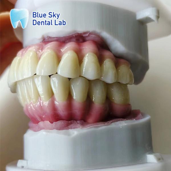 Cas d'implant de la bouche entière personnalisé Compatibilité universelle