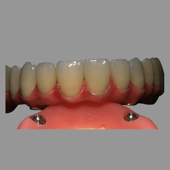 Dental Implant Lab | Class 2 Hybrid Malong Full Arch AOX Implant Bridge Titanium Bar With Full Solid Zirconia