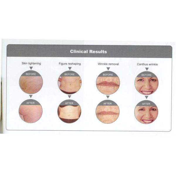 Home Rf Skin Rejuvenation Multifunction Beauty facial machine 6 in 1 For All Color Skin