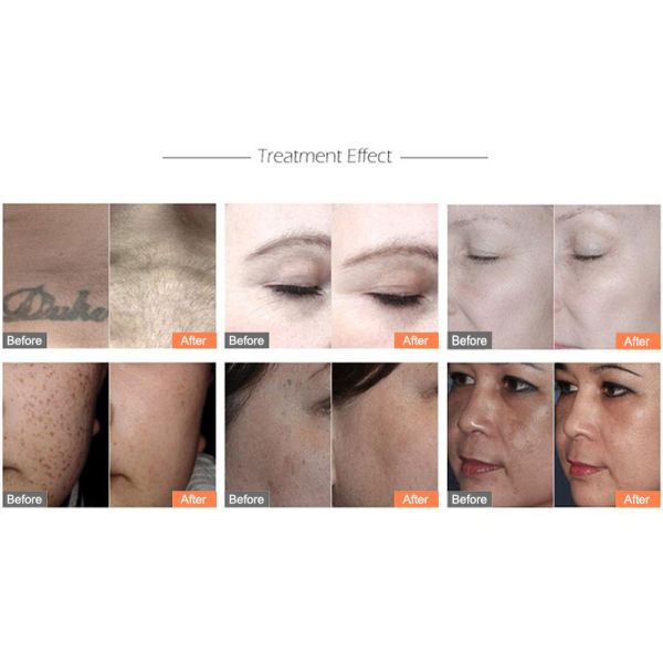 Carbon Peel Laser Tattoo Removal Machine Facial Cleansing Beauty Salon Equipment